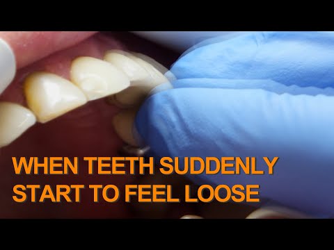 वीडियो: क्या दांतों का थोड़ा झड़ना सामान्य है?