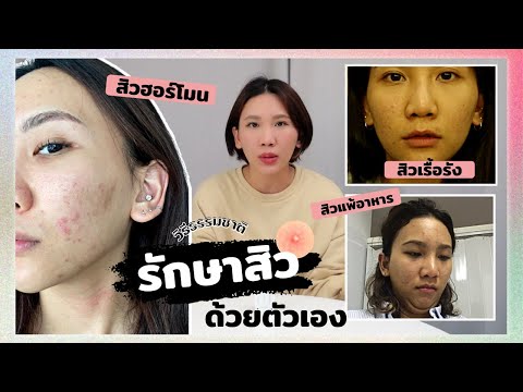 How to รักษาสิวเรื้อรังด้วยวิธีธรรมชาติ ไม่ต้องเข้าคลินิก I CU.FITGIRL