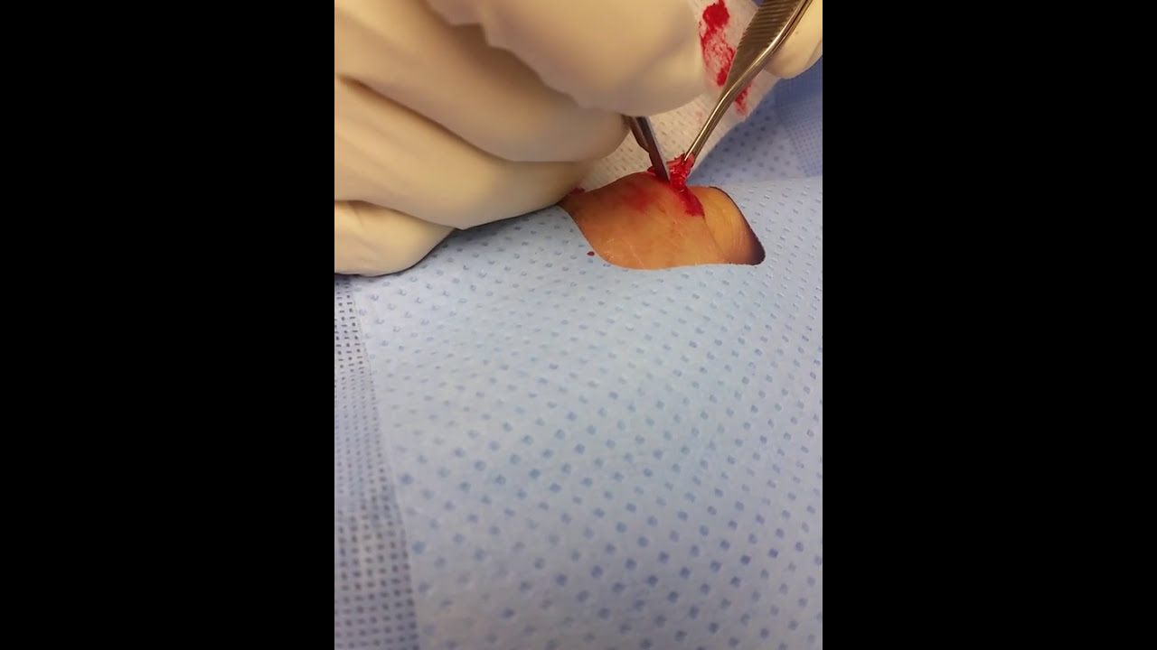 Gout surgery - YouTube