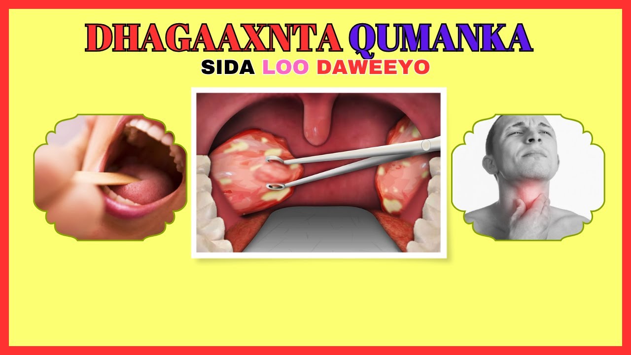 Sida Isaga Dawee Dhagaxaanta Qumanka / Qanjaha - YouTube