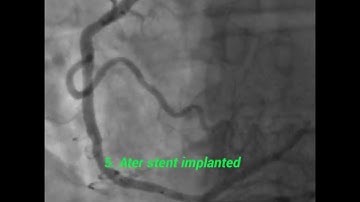 Occlusion  right coronary atery, treatment with stent implant.