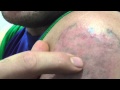 Salabrasion Tattoo Removal Update