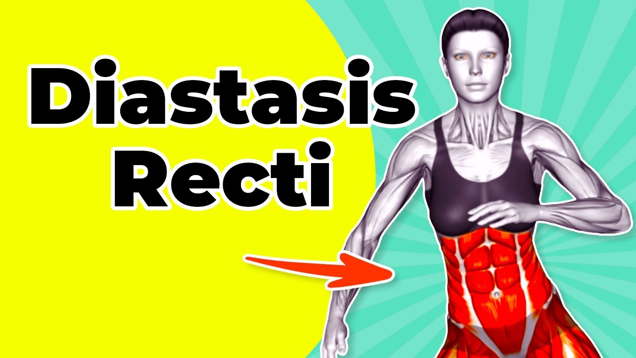 Diastasis Recti: A Medical Condition That Should Not Be Ignored