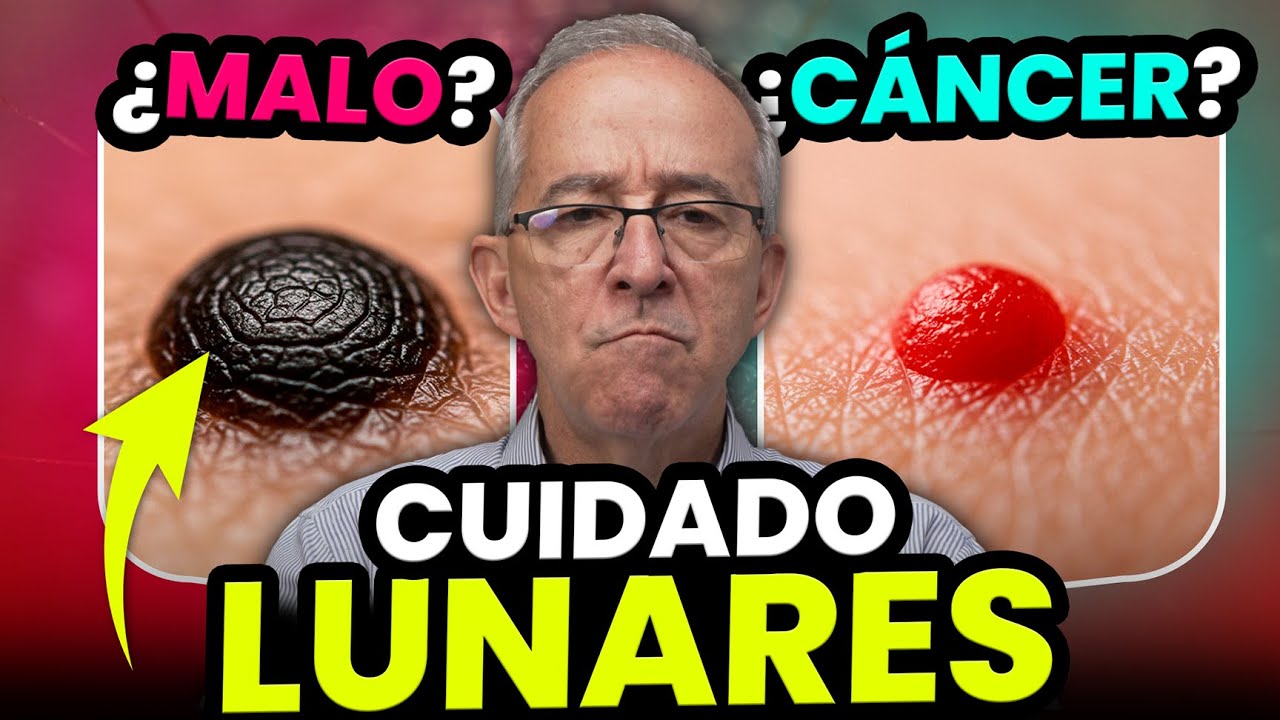 🟤 QUE LUNARES Son SOSPECHOSOS - Oswaldo Restrepo RSC