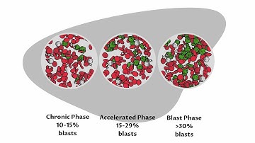 Treatment Options for Chronic Myeloid Leukemia (CML) -