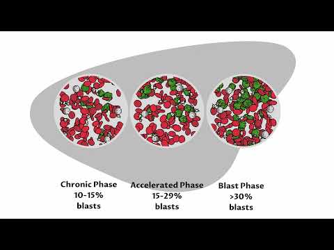 Understanding Chronic Myeloid Leukemia (CML) - Treatment options
