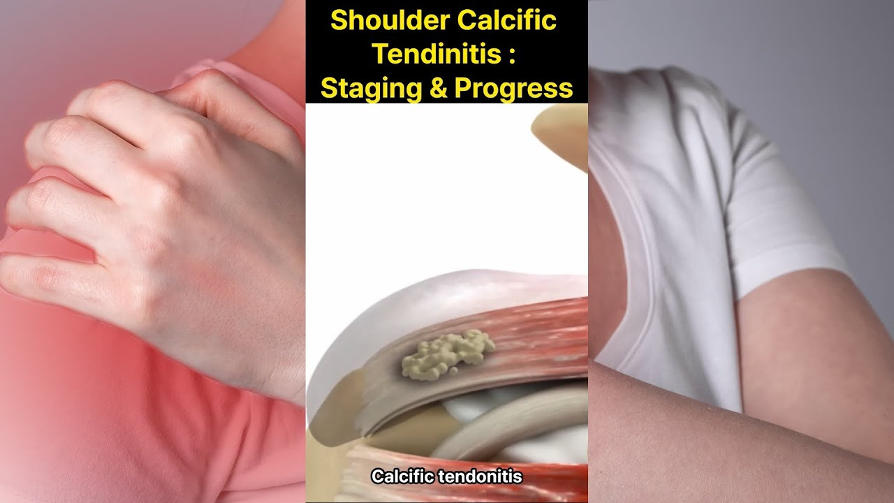 Shoulder Calcific Tendinitis: Stages and Progression 어깨 석회성 건염: 진행 단계와 과정