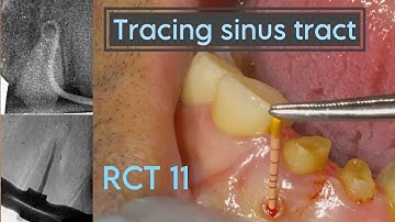 Tracing sinus tract and Root canal treatment Central Incisor #rootcanal #fistula