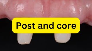 Post and core indications and steps SIMPLIFIED
