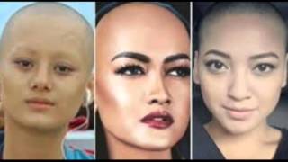 rambut jupe botak news