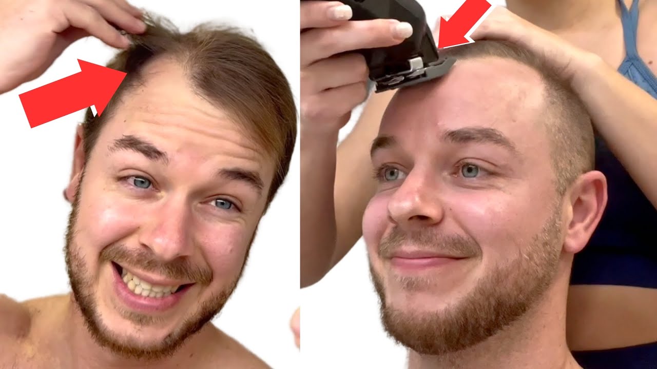 SHAVING My RECEDING HAIRLINE To A Grade 1 BUZZ CUT *Transformation* 