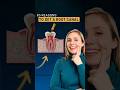 5 Reasons You Need a Root Canal | Save Your Tooth, Skip the Pain