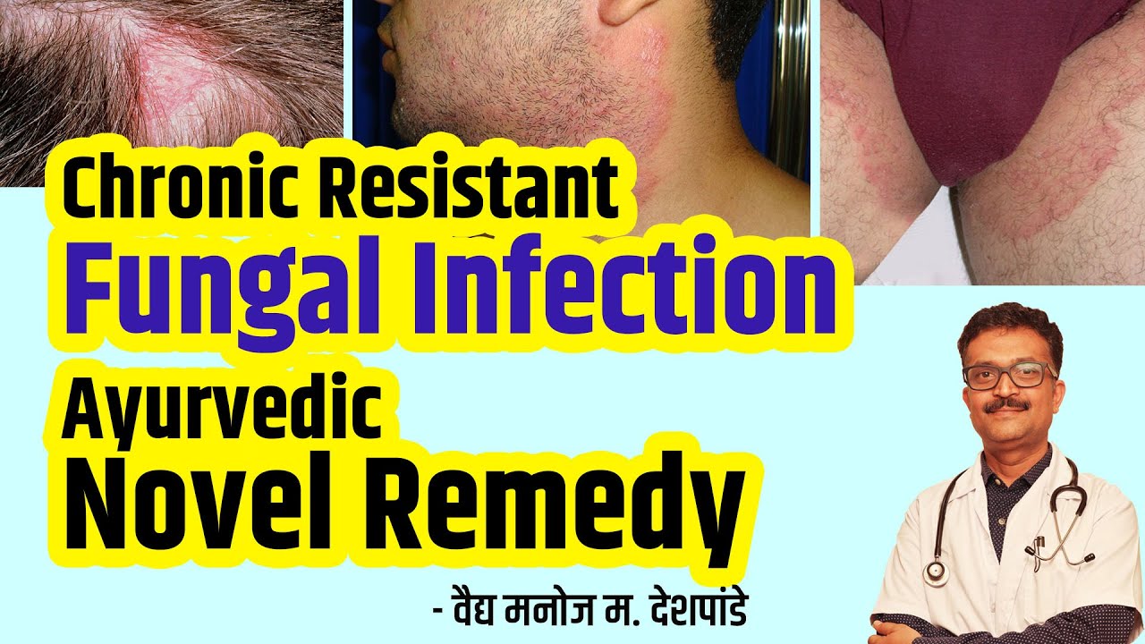 Effective treatment for fungal infection फंगल इन्फेकशन वर प्रभावी