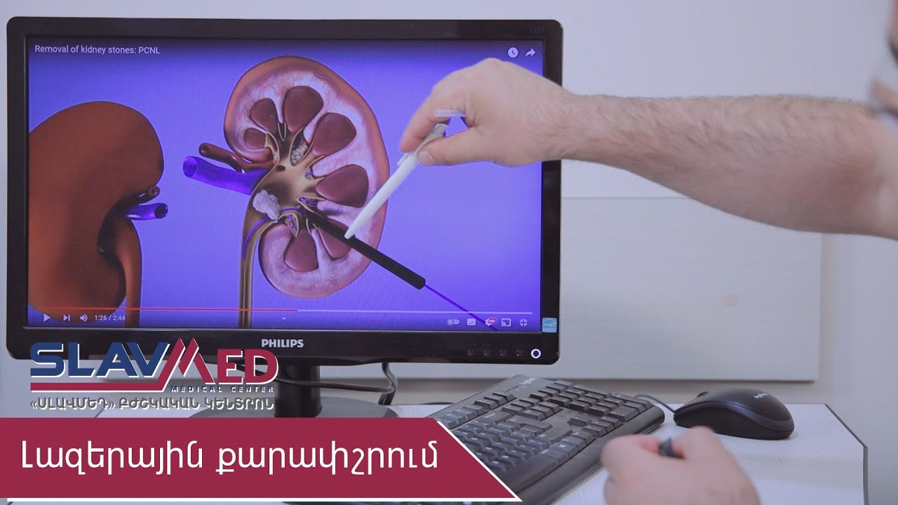 Լազերային քարափշրում