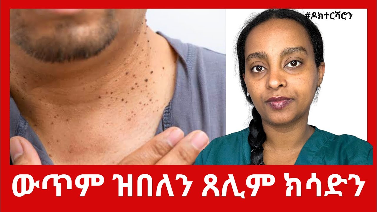 ኣብ ቆርበት ዝወጽእ ውጥም ውጥም ዝበለን ጸሊም ክሳድን ዝምለሰሉ ቀሊል ኣገባብ