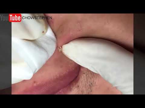 BLACKHEADS AROUND THE MOUTH  BLACKHEADS AROUND THE MOUTH