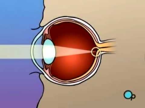 Vista Eye Laser Surgery