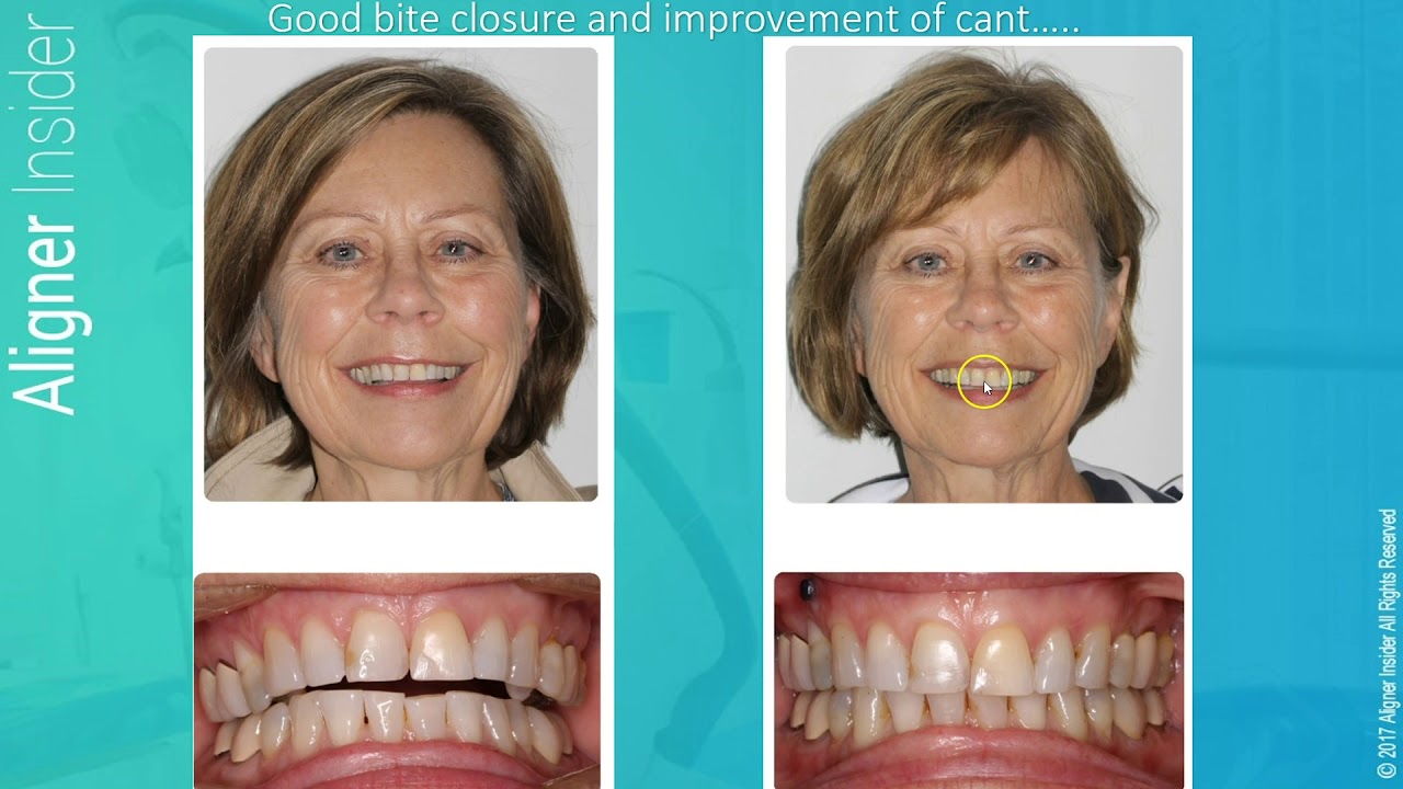 Aligner Insider Invisalign Case Studies with special presenter Dr
