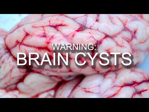 Video: Retrocerebellar Cyst Of The Brain: What Is Dangerous, Treatment