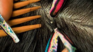 Asmr Close Attentive & Tingly Nitpicking Whiteheads Soothing Whispers