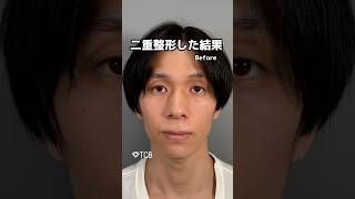【二重整形】二重整形した結果#shorts