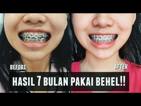 TMJ DISORDER (GANGGUAN SENDI RAHANG) | Danti Narulita. 