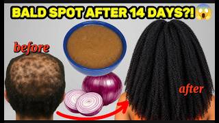 JUST MIX THESE 2 THINGS WITH RAW ONION! 😱 TRY THIS FOR 3 DAYS