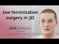 Jawcontour  3d precision in jaw and chin feminization surgery