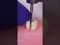 Zekrya Bur 🟡 Tooth Sectioning Demonstration 🔵 PreciDent Made in India Burs #wisdomtoothextraction