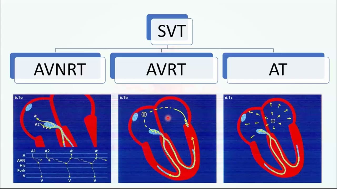 أساسيات الدراسة الكهروفیزیولوجیة للقلب(تحليل أنواع تسرع القلب فوق البطيني أثناء التسرع)Basic of EPS)