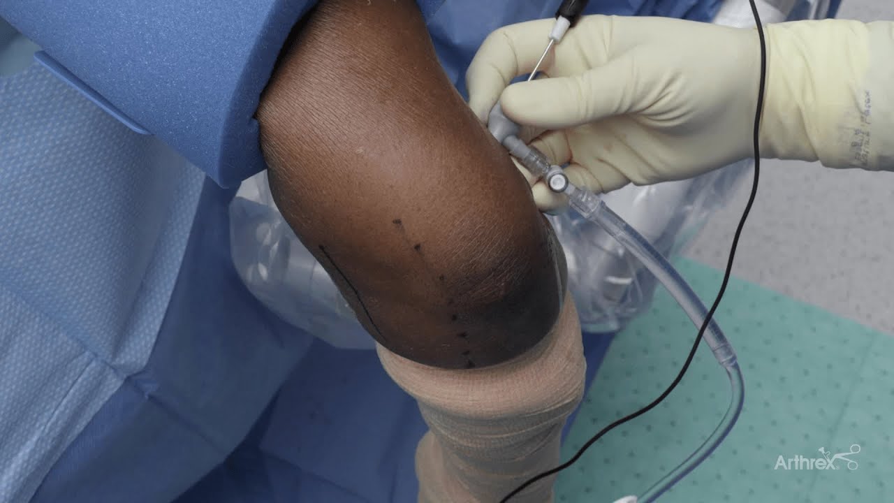 Elbow Arthroscopy Using the NanoNeedle Scope System - YouTube