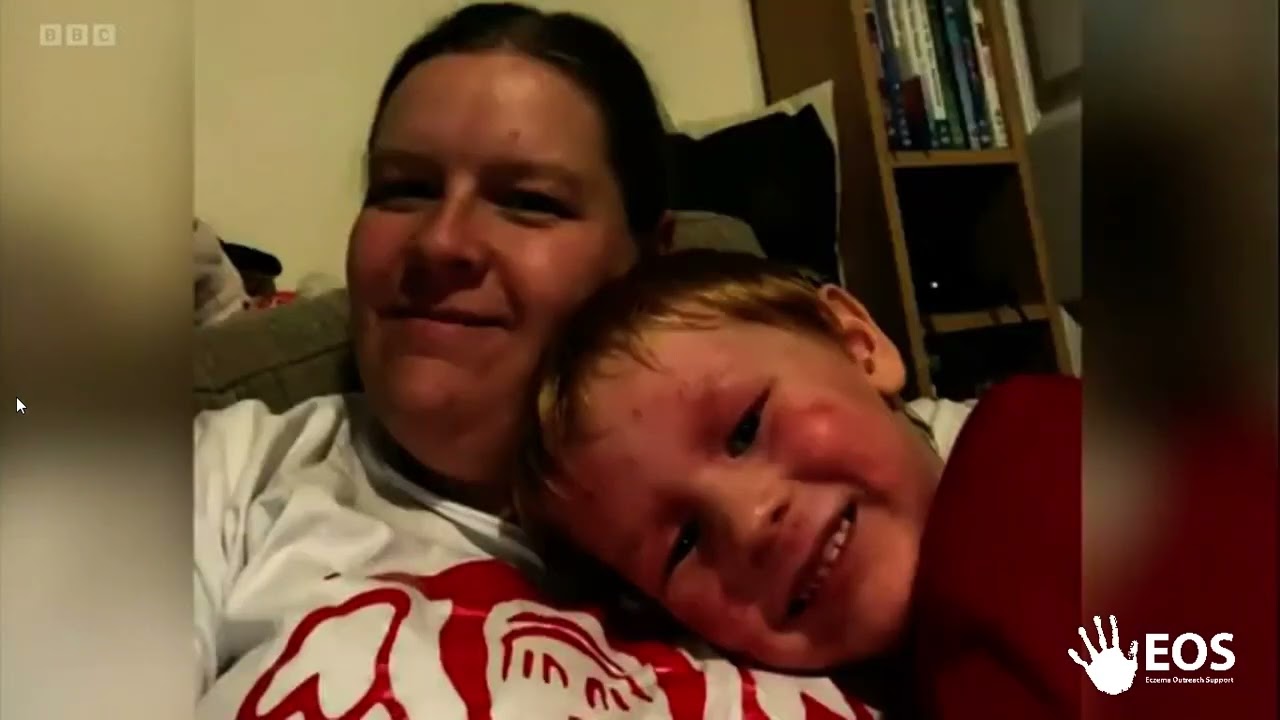 Eczema Outreach Support member George appears on BBC South to talk about eczema