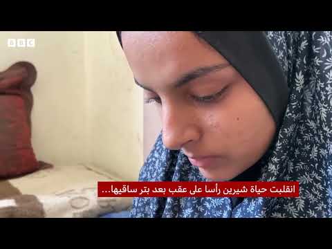 غزة: انهيار النظام الصحي يدفع الأطباء لإجراء عمليات بتر