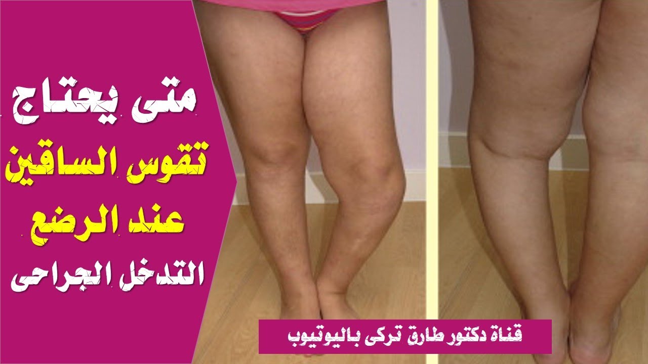 متى يحتاج تقوس الساقين عند الرضع التدخل الجراحى