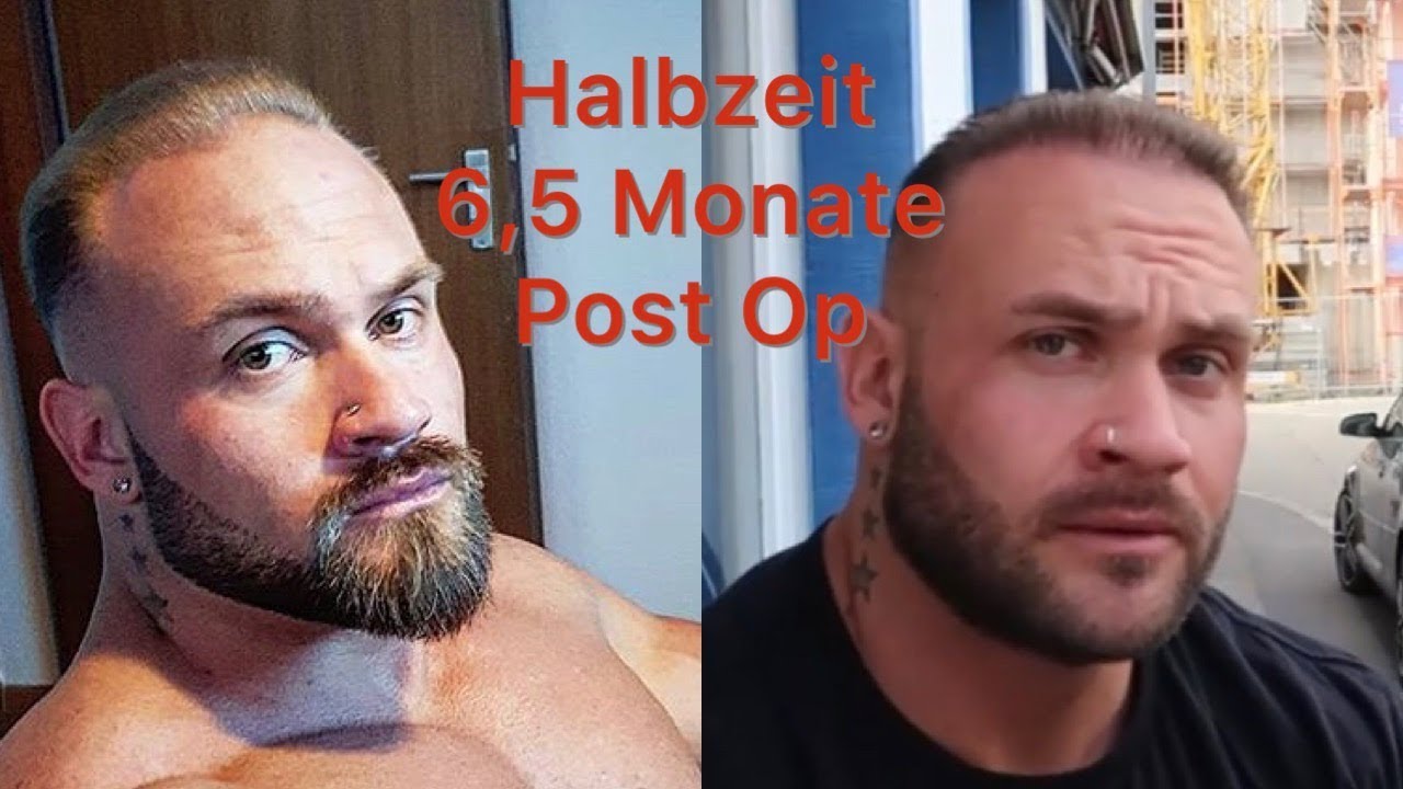 4 monaten 5 nach haartransplantation Haarverpflanzung FAQ`s