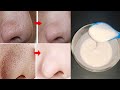 How to remove blackheads and whiteheads permanently