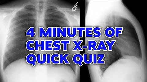 4 minutes of chest X-ray pattern recognition quiz | pathology
