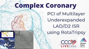 Watch Live PCI of Multilayer Underexpanded LAD/D2 ISR using RotaTripsy