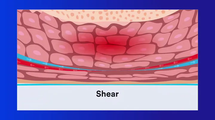 Pressure Injury Education: Chapter 2 Cause - DayDayNews