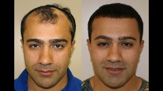 Hair Transplant with Latest Technology by Dr. Shradda Uprety, MD | Chitwan Medical College