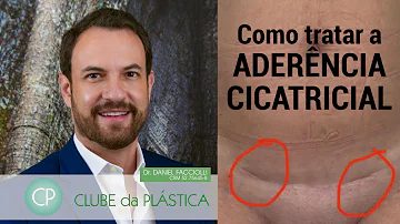 Como saber se tenho aderência Pelvica?