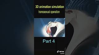 Gender reassignment surgery male to female surgery slowed version part 4