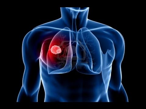mesothelioma-cancer-|-mesothelioma-treatment-|-mesothelioma-cancer-research-2016