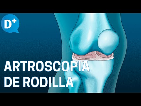 Vídeo: Artroscopia De Rodilla: Razones, Procedimiento Y Beneficios