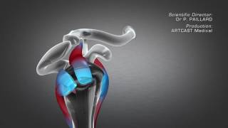Standard or reverse shoulder replacement