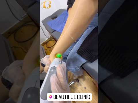 اختاري اللي يناسبك مع جلسات ازاله الشعر بالليزر هتفضلي تعملي ليزر طول العمر تجميل 