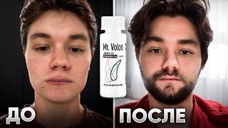 картинка: ОТРАСТИЛ БОРОДУ ЛЕСНИКА с НУЛЯ. Результаты применения Mr.VOLOS 5% и 15%