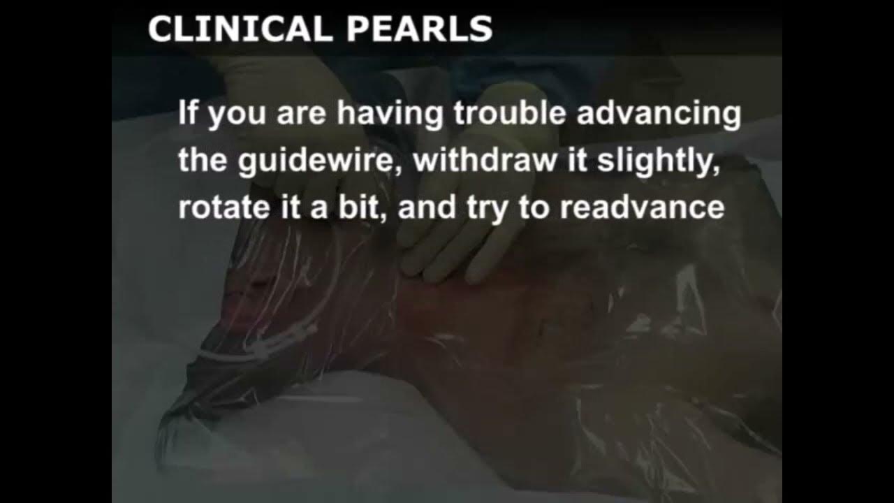 042 Central Venous Catheterization Internal Jugular Approach Procedure Videos Cheap Ebooks