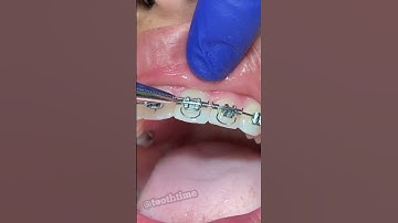 Torque Springs Orthodontics - Braces On - Tooth Time Family Dentistry New Braunfels