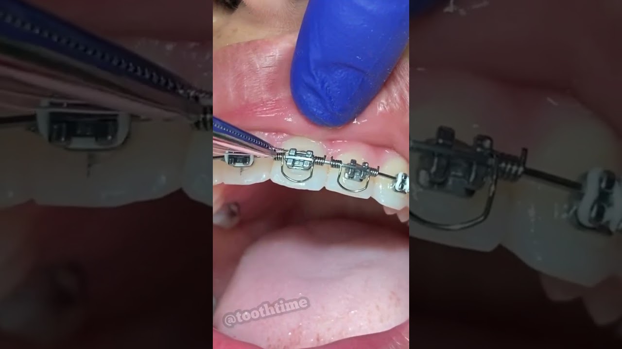 Ортодонтия Torque Springs - Брекеты на ногах - Семейная стоматология Tooth Time в Нью-Браунфелсе